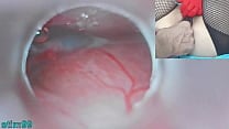 Japanese Insemination with Cum into Uterus and Endoscope Camera by Cervix to watch inside womb Uncensored Japanese Insemination with Cum into Uterus and Endoscope Camera by Cervix to watch inside womb Uncensored