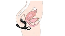 Estimulacion Rectal Estimulacion Rectal