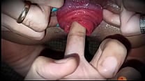 Prolapse finger
